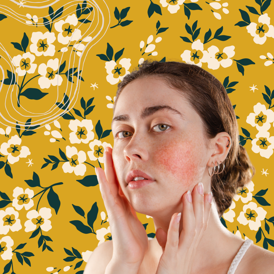 Golden chamomile for Rosacea