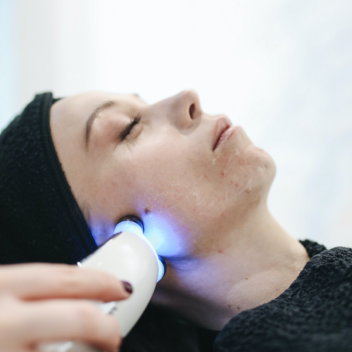 Unveiling the Light Laser Treatment Options for Rosacea StoicBeauty