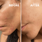 Before and after acne treatment results