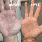 Eczema hand cream before and after treatment, visible skin improvement.