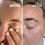 Eye eczema before and after treatment, improved skin