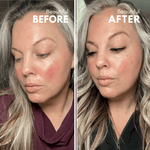 Rosacea prone skin before and after treatment, beautiful results.